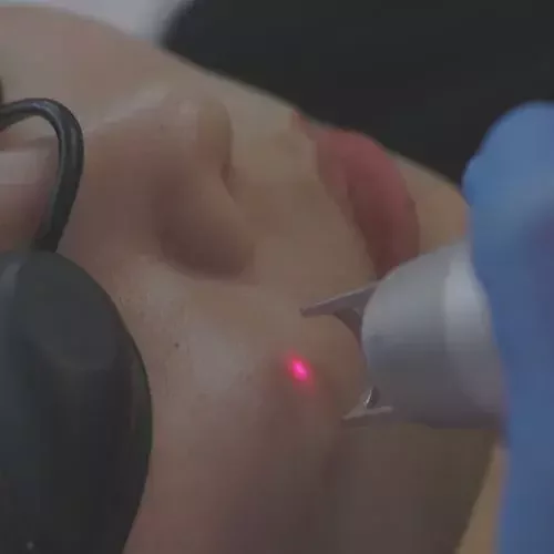 Doctor performing the Korean laser treatment on the patient’s facial skin, targeting pigmentation and uneven skin tone.