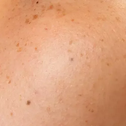 Close-up of facial skin showing dark spots left after healed acne or skin inflammation, typical of post-inflammatory hyperpigmentation (PIH).'