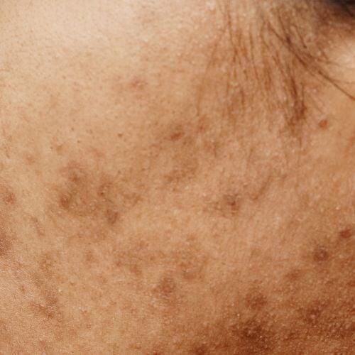 Picture of face with post acne scars 