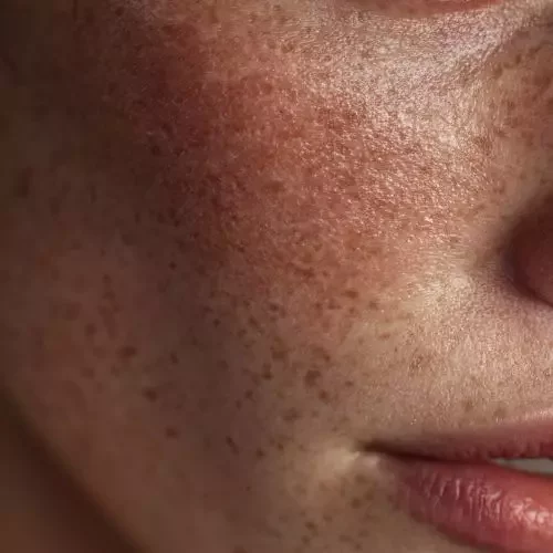 Close-up of facial skin displaying freckles and sunspots, appearing as small, scattered brown pigmentation spots caused by sun exposure.