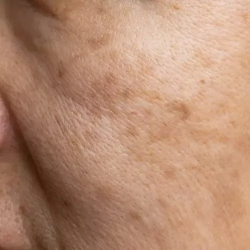 Close-up of facial skin showing irregular brown patches on the cheeks and forehead, characteristic of melasma pigmentation.