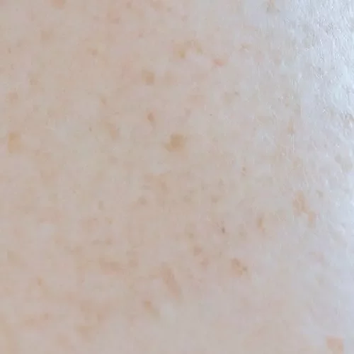 Close-up of facial skin showing uneven skin tone, with areas of lighter and darker pigmentation across the cheeks and forehead.