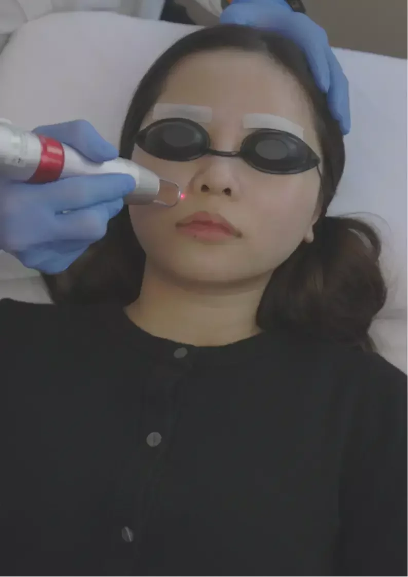 Korean laser treatment being performed on a patient, demonstrating how the device targets pigmentation and uneven skin tone.